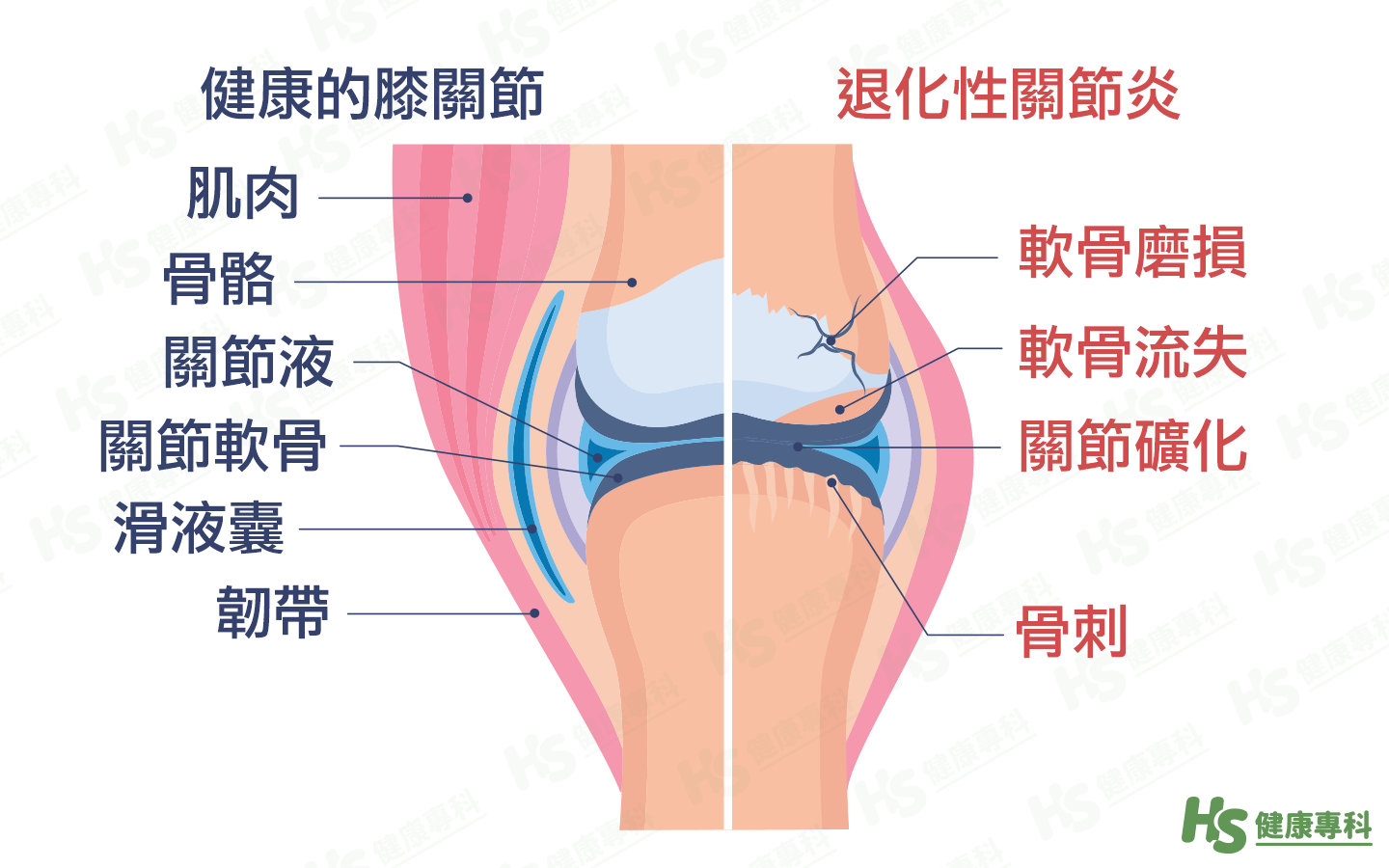 何謂退化性關節炎？  外科防治室